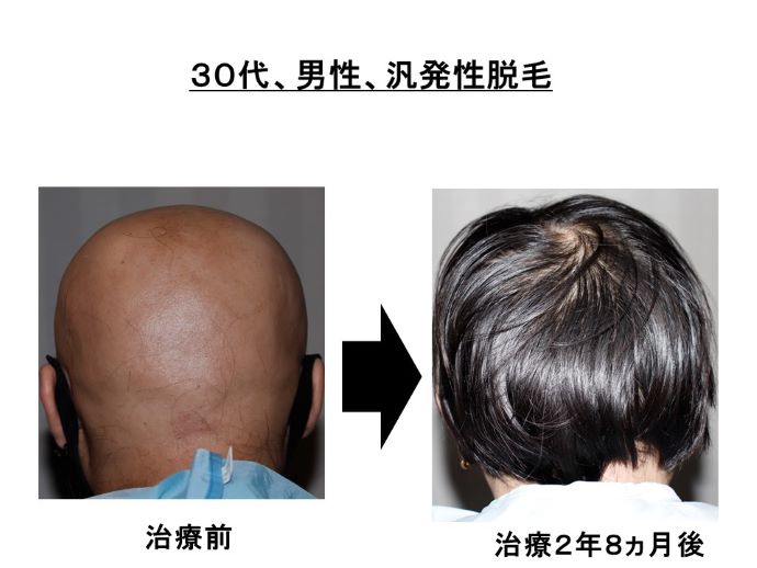 円形脱毛症　病院